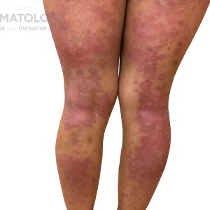 DermAtlas_Atopic dermatitis_lower-extremity-posterior-10.30.2023-58759726 1