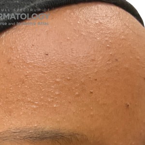 DermAtlas_Comedonal acne_face-oblique-right-10.30.2023-58751034