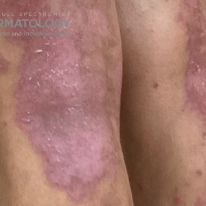 DermAtlas_Atopic dermatitis_lower-extremity-posterior-oblique-left-10.30.2023-58759703 3