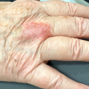 DermAtlas_Nummular eczema_11.06.2023-59163849