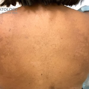 DermAtlas_Versicolor_back_GW1 3