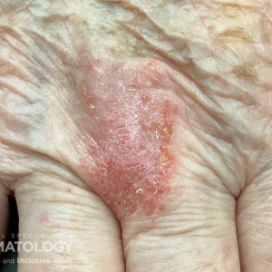 DermAtlas_Nummular eczema_11.06.2023-59163816