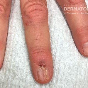 DermAtlas_Friedman-11.27.2023-60210510 DIGITAL MUCOUS CYST