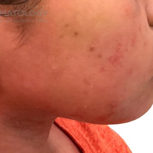 DermAtlas_Atopic dermatitis_face-lateral-right-10.30.2023-58759255