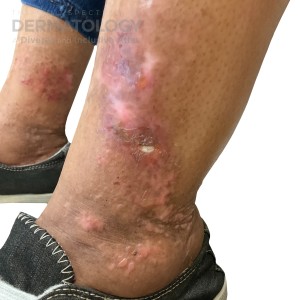 Bullous pemphigoid -11.10.2023-59474979