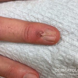 DermAtlas_Friedman-11.27.2023-60219359 Digital mucous cyst