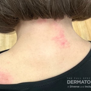 DermAtlas_GW_-10.25.2023-58751014 -  dermatomyositis