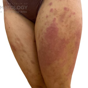 DermAtlas_Atopic dermatitis_lower-extremity-anterior-oblique-left-10.30.2023-58759579