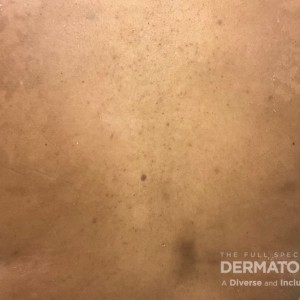 DermAtlas_Versicolor_back_GW2