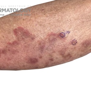 DermAtlas_Majocchi granuloma2