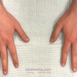 DermAtlas_AtopicDerm_Hands_B_031824