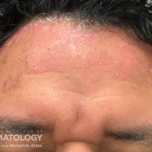 DermAtlas_Scalp psoriasis -12.18.2023-61474690