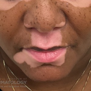 DermAtlas_Vitiligo_mouth-01.08.2024-62281295 copy