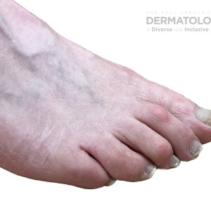 DermAtlas_Onychomycosis -01.22.2024-63021037