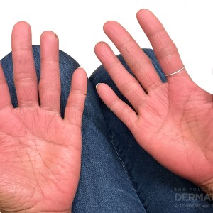 DermAtlas_Fissures and cracking of hands -12.06.2023-60780099