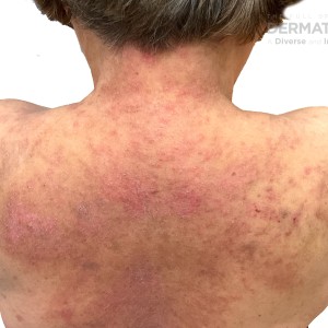 DermAtlas_Pustular psoriasis_2.04.2023-60644731