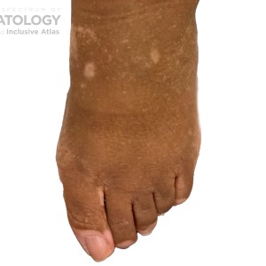 DermAtlas_Vitiligo_-01.08.2024-62281620