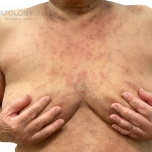 DermAtlas_Pustular psoriasis_-12.04.2023-60644872 copy