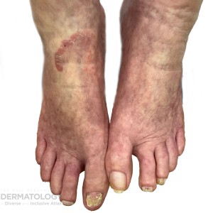 DermAtlas_unmarked_foot_B_031824.2