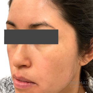 DermAtlas_Rosacea and Seborrheic dermatitis_face-oblique-left-12.11.2023-61063278