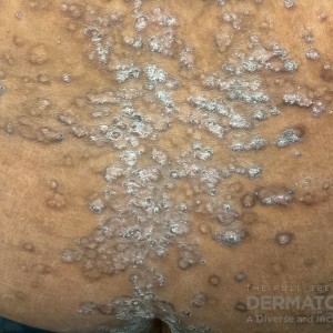 DermAtlas_psoriasis-04.22.2024-68130838