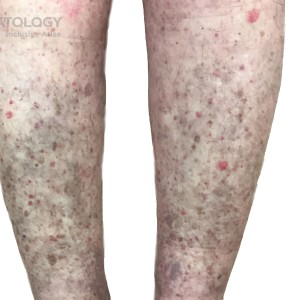 DermAtlas_Leucocytoclastic Vasculitis_legs_B_031824.1