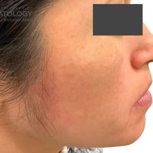 DermAtlas_Rosacea and Seborrheic dermatitis_face-lateral-right-12.11.2023-61069381