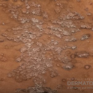 DermAtlas_psoriasis_closeup-04.22.2024-68130816