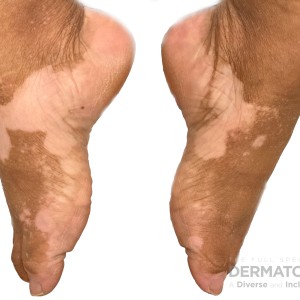 DermAtlas_Vitiligo_-01.08.2024-62281659