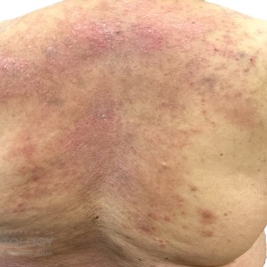 DermAtlas_Pustular psoriasis_-12.04.2023-60644796