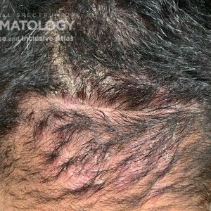 DermAtlas_Scalp psoriasis -12.18.2023-61475197