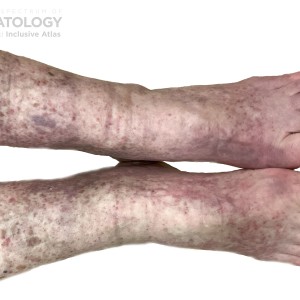 DermAtlas_Leucocytoclastic Vasculitis_Legs_B_031824