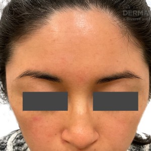 DermAtlas_Rosacea and Seborrheic dermatitis_face-chin-down-12.11.2023-61069416