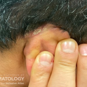 DermAtlas_Scalp psoriasis -12.18.2023-61474761