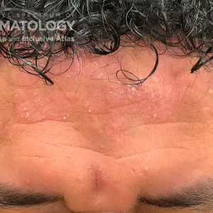 DermAtlas_Scalp psoriasis -12.18.2023-61475196