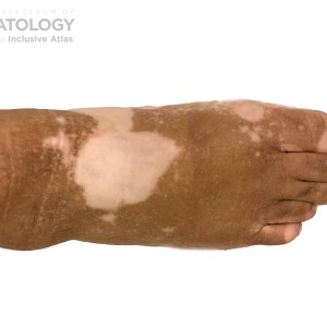 DermAtlas_Vitiligo_-01.08.2024-62281546