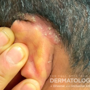 DermAtlas_Scalp psoriasis -12.18.2023-61474816